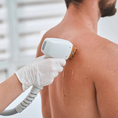 Men's Full Back Laser Hair Removal